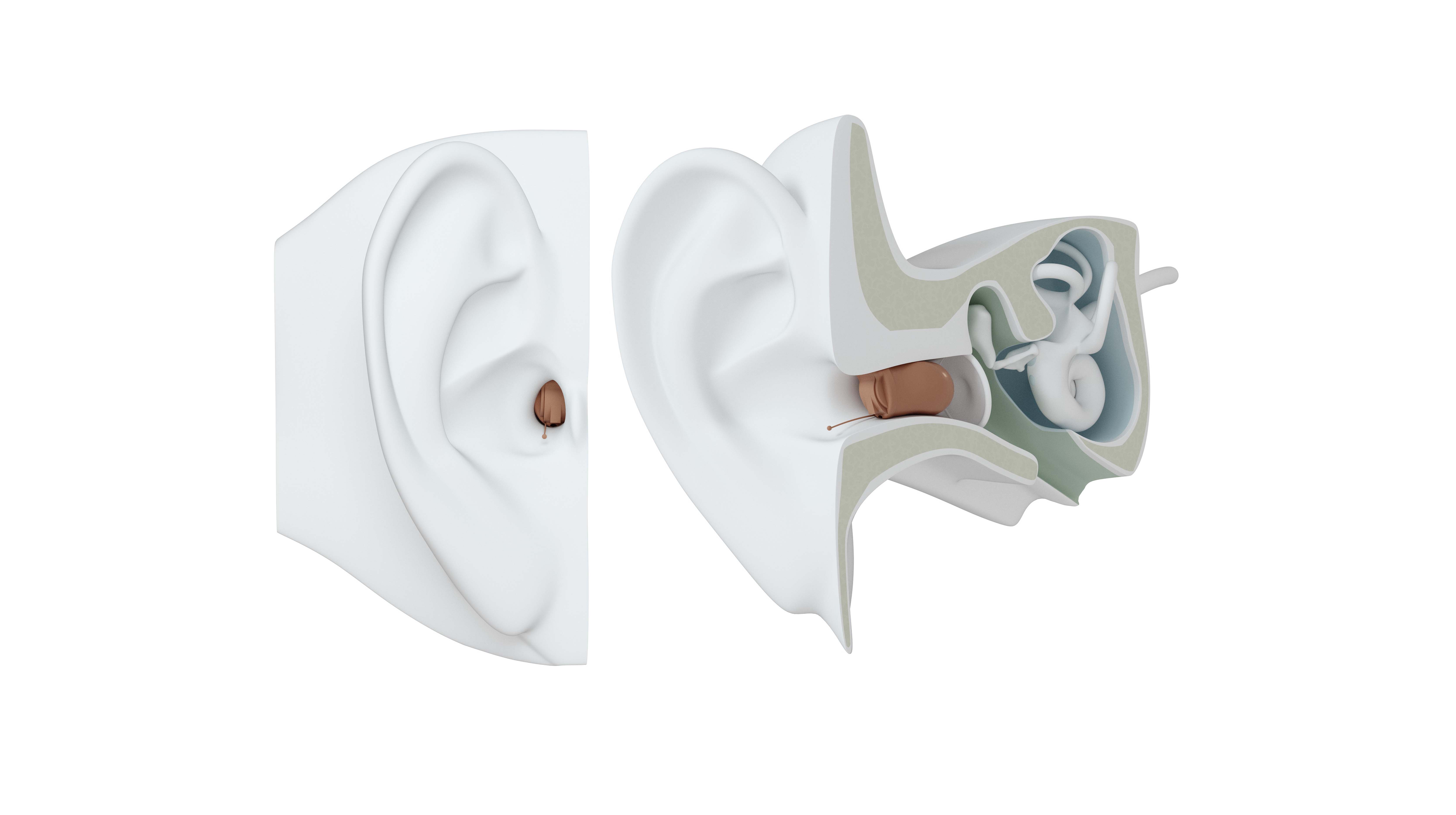 IIC hearing aid on ear.