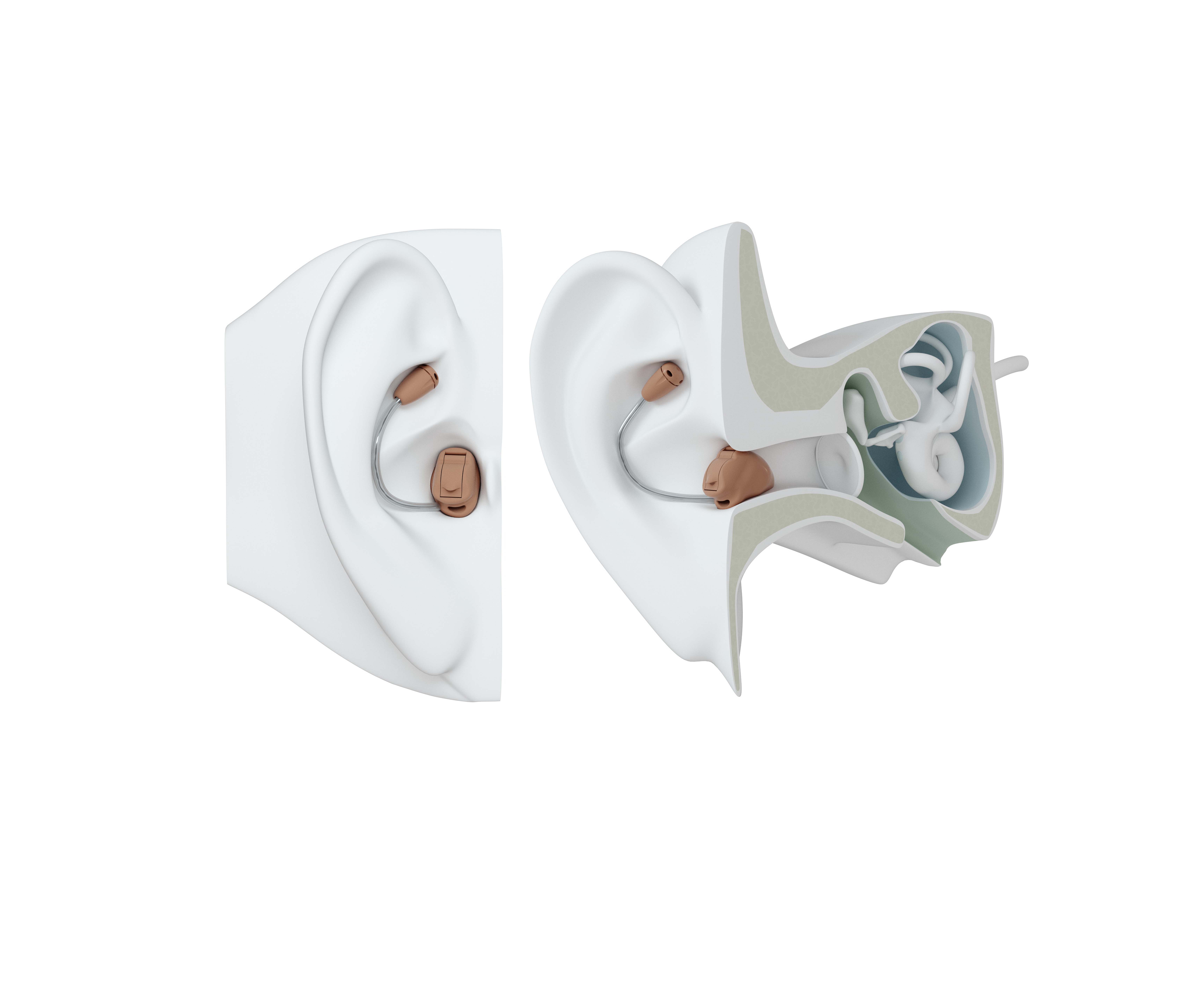 MIH hearing aid on ear.