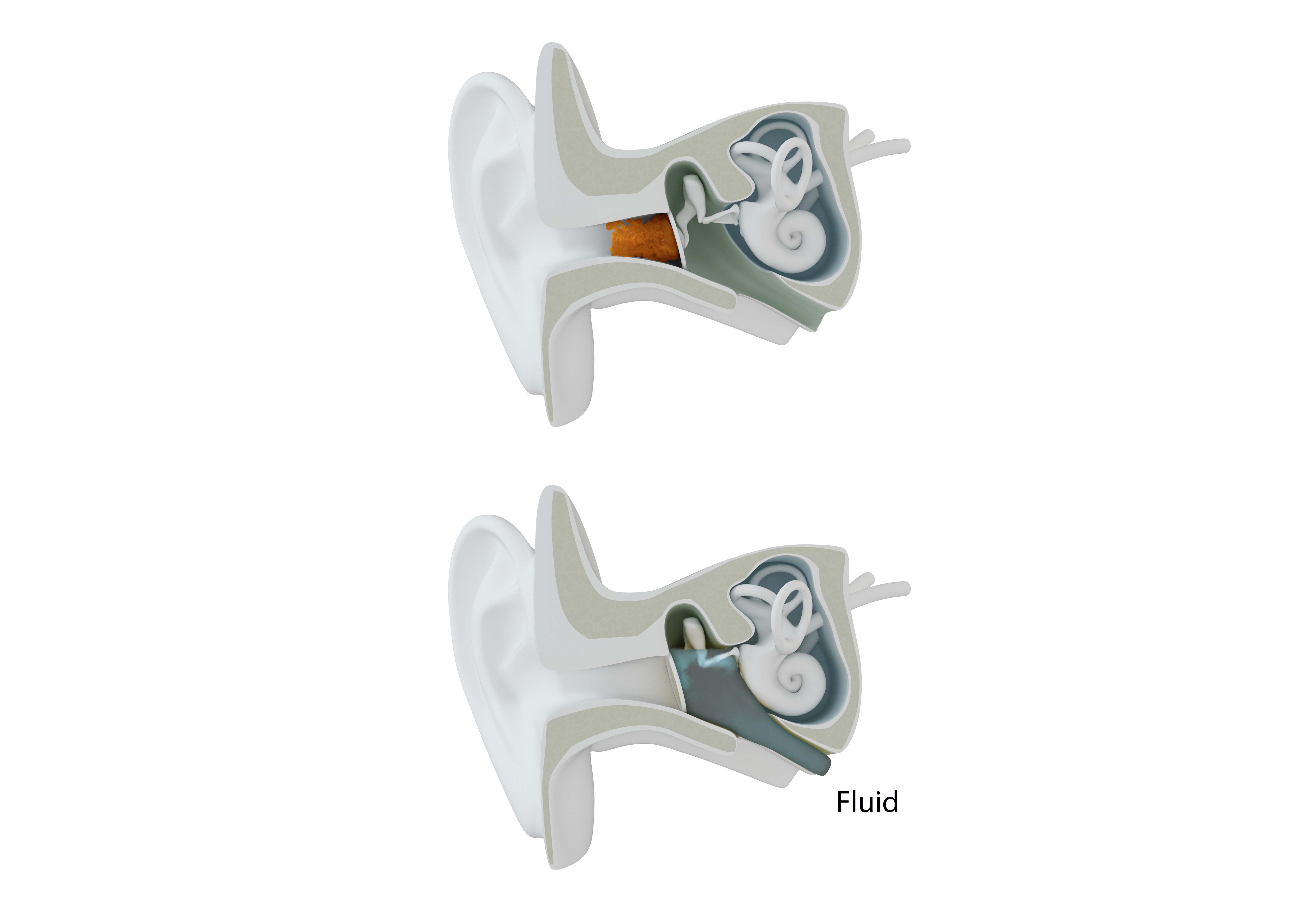 Ear blockage due to fluid.
